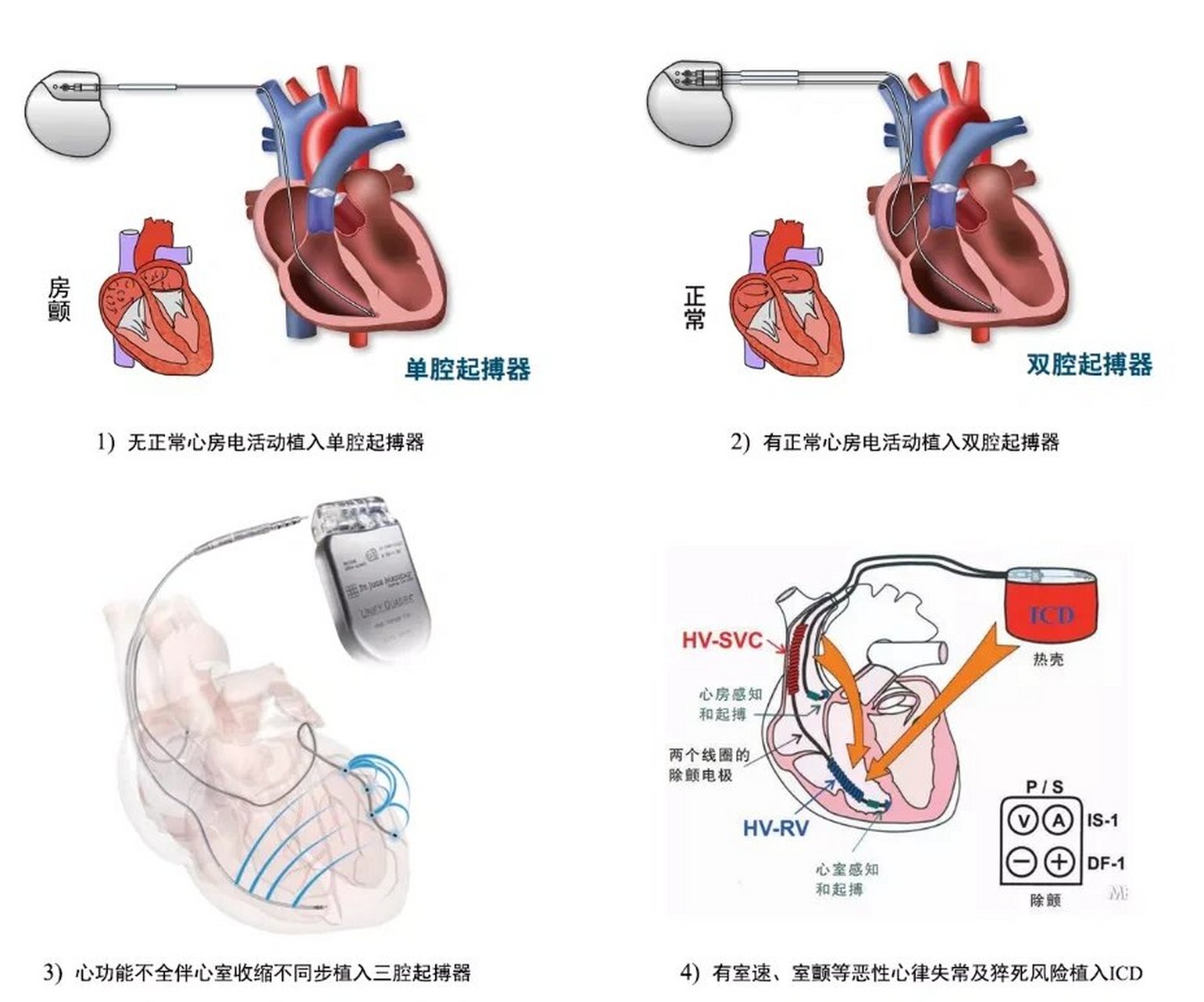 认识一下心脏起搏器吧 心脏起搏器是一种植入于体内的电子治疗仪器