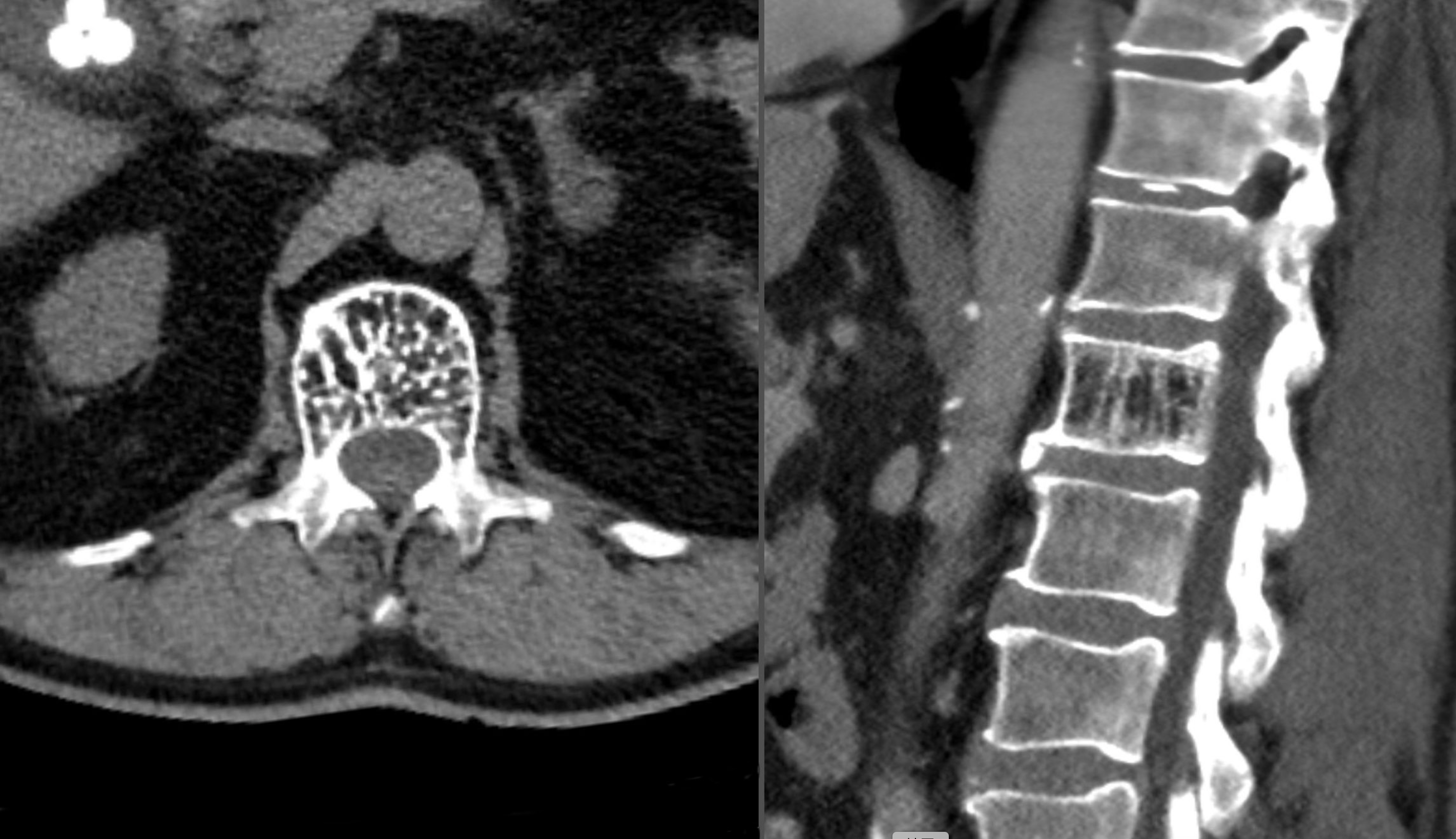 脊柱椎体内血管瘤