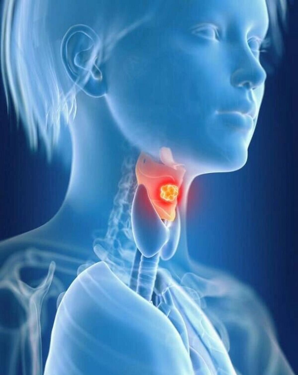 咽喉癌图片 症状早期图片