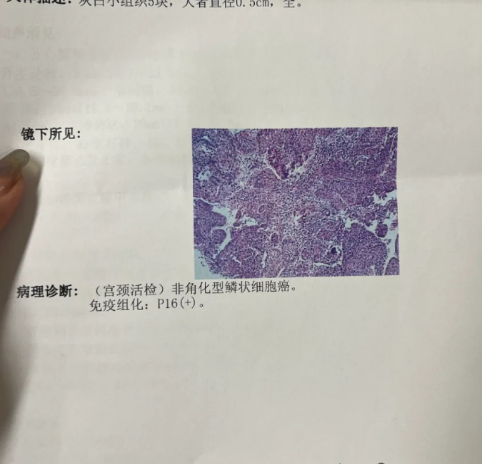 看到平滑淡薄醋白上皮的表现时,需要结合具体病因来判断严重程度