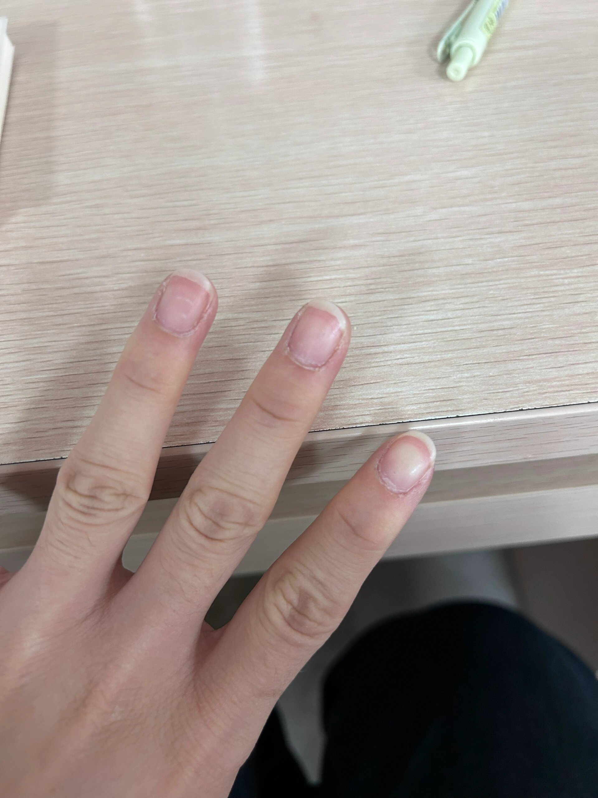手指伸直指甲盖就发白,有无有医学生呀