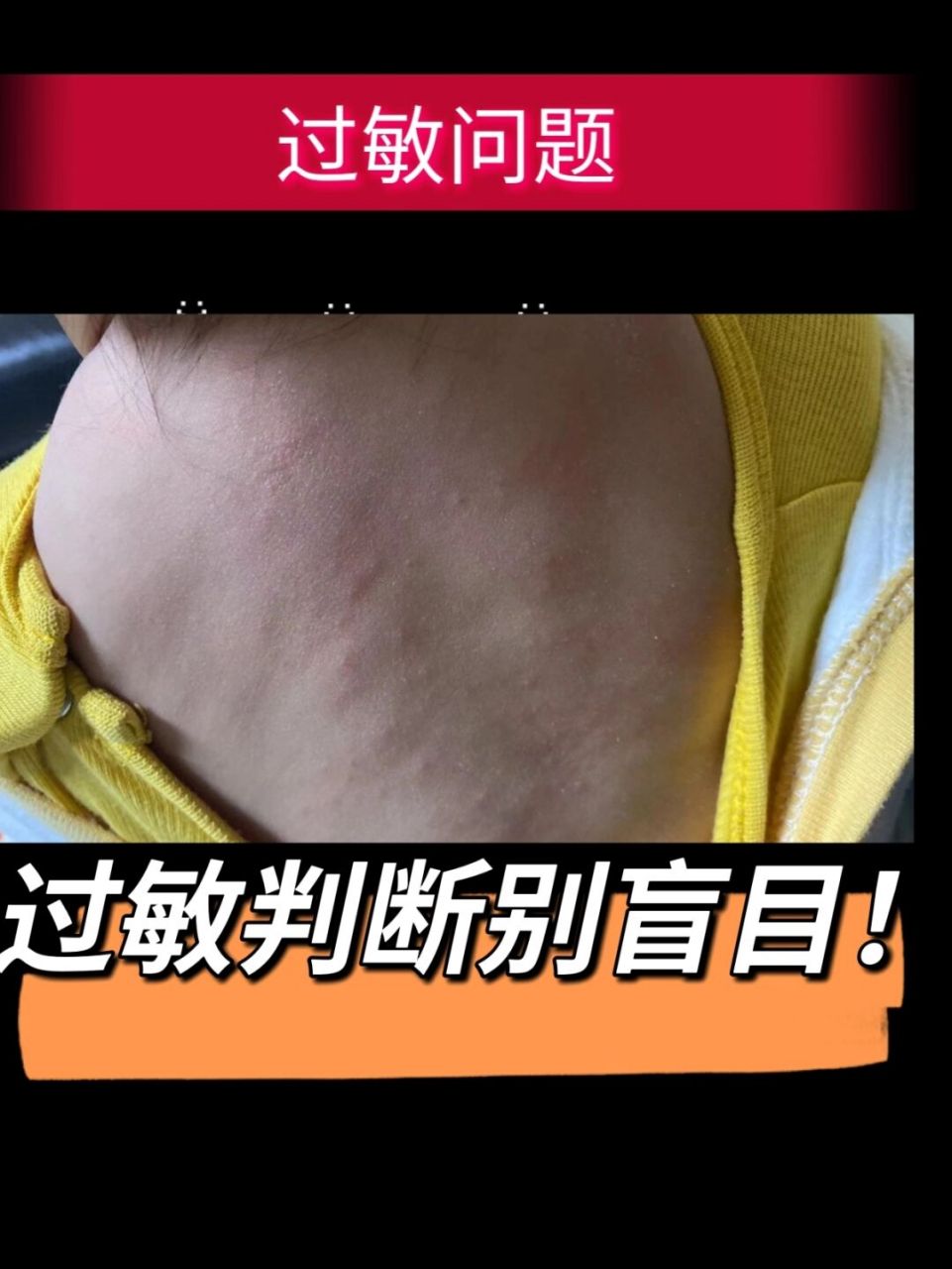 牛奶蛋白过敏宝宝判断心得总结 下面我们说一下孩子过敏的原因: 主要
