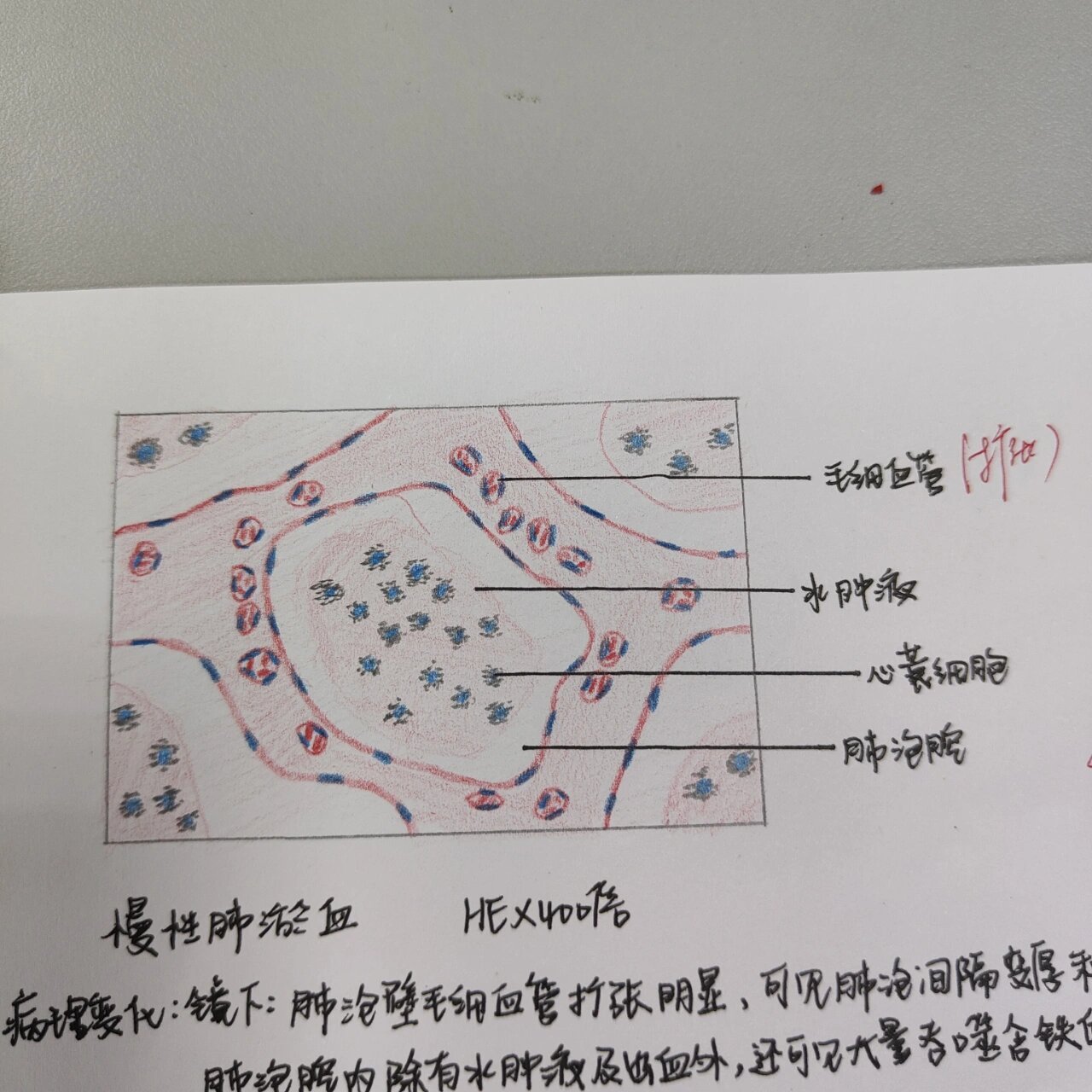 肺水肿红蓝铅笔手绘图图片