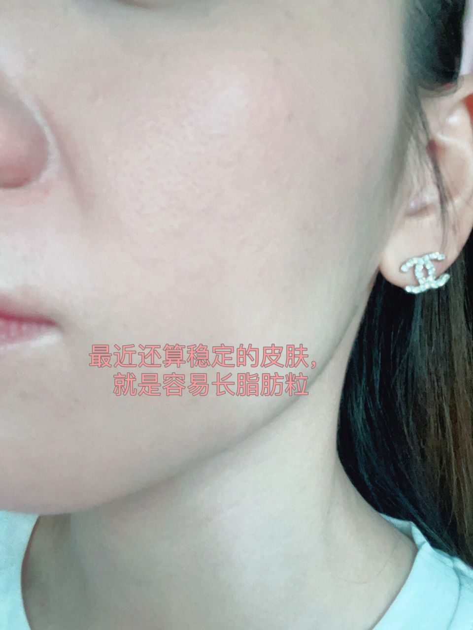 维生素e乳拯救了我的过敏 上一篇提到脸过敏,我的症状是脸颊两边在