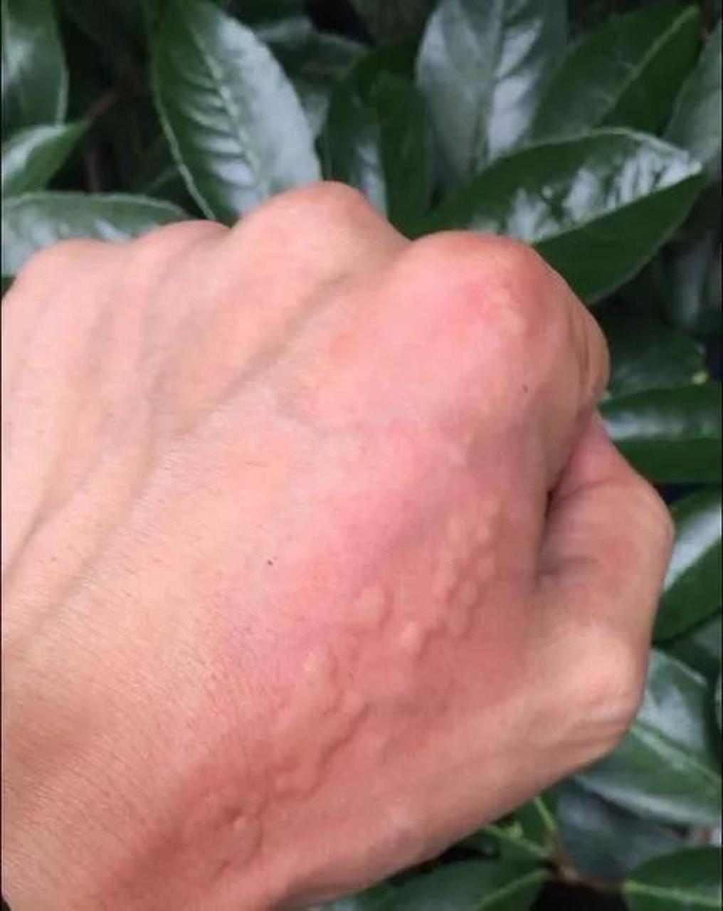 上周末去了一个枣园,没想到一个蛰啦毛子落到了胳膊上,然后感觉就像