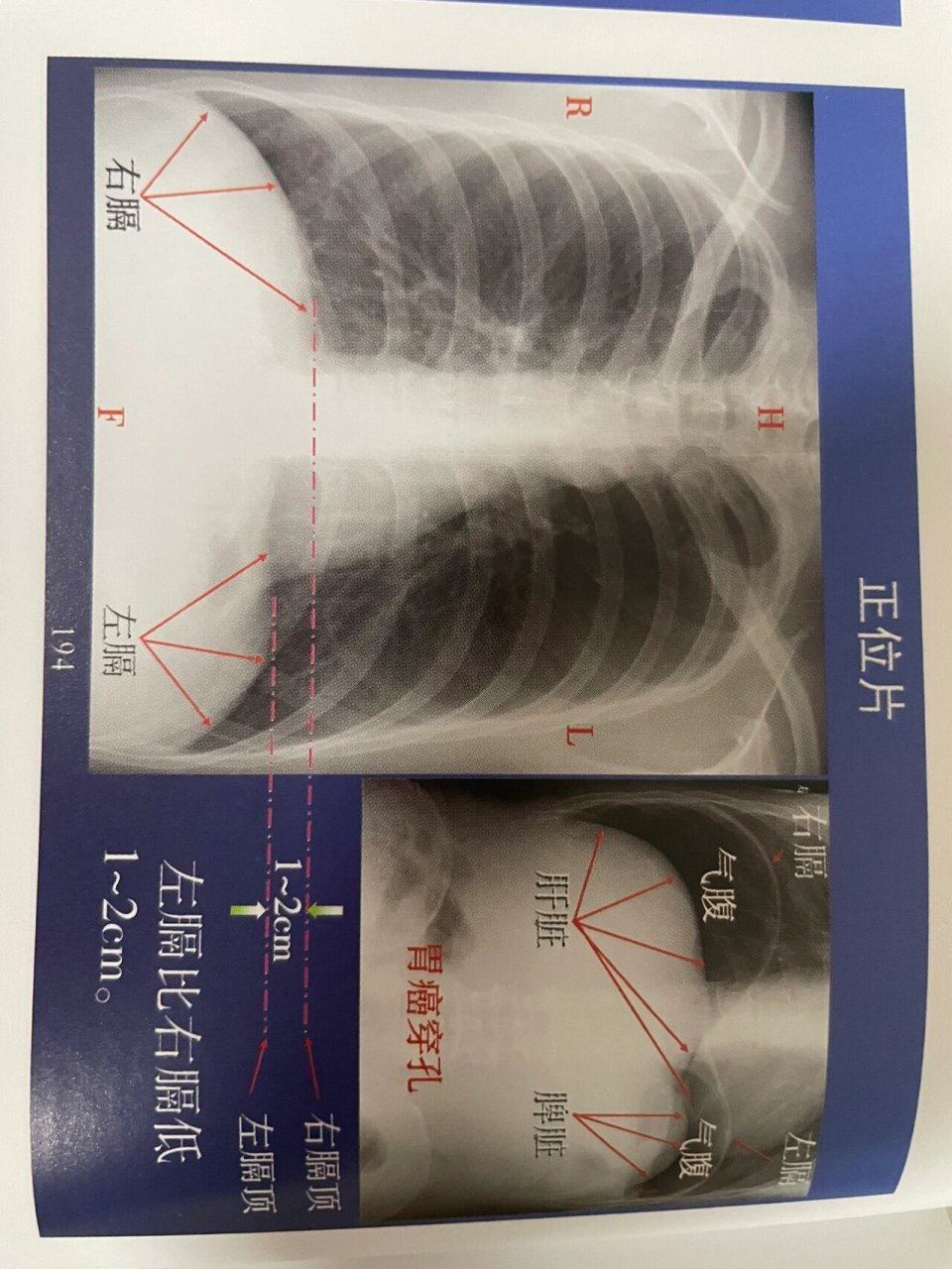 肋膈角变钝图片