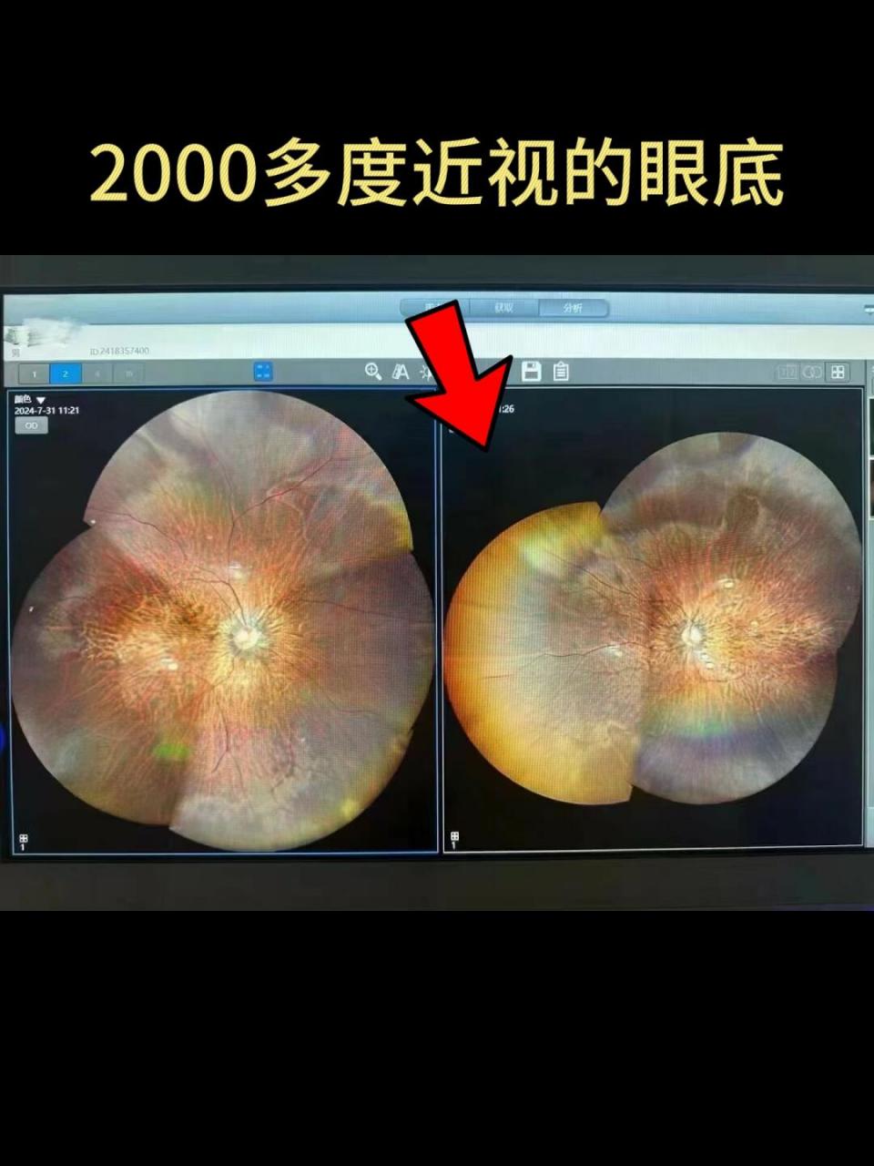 眼科医生经常说的眼底检查,到底是什么呢? 👉是通过专业的仪器检查