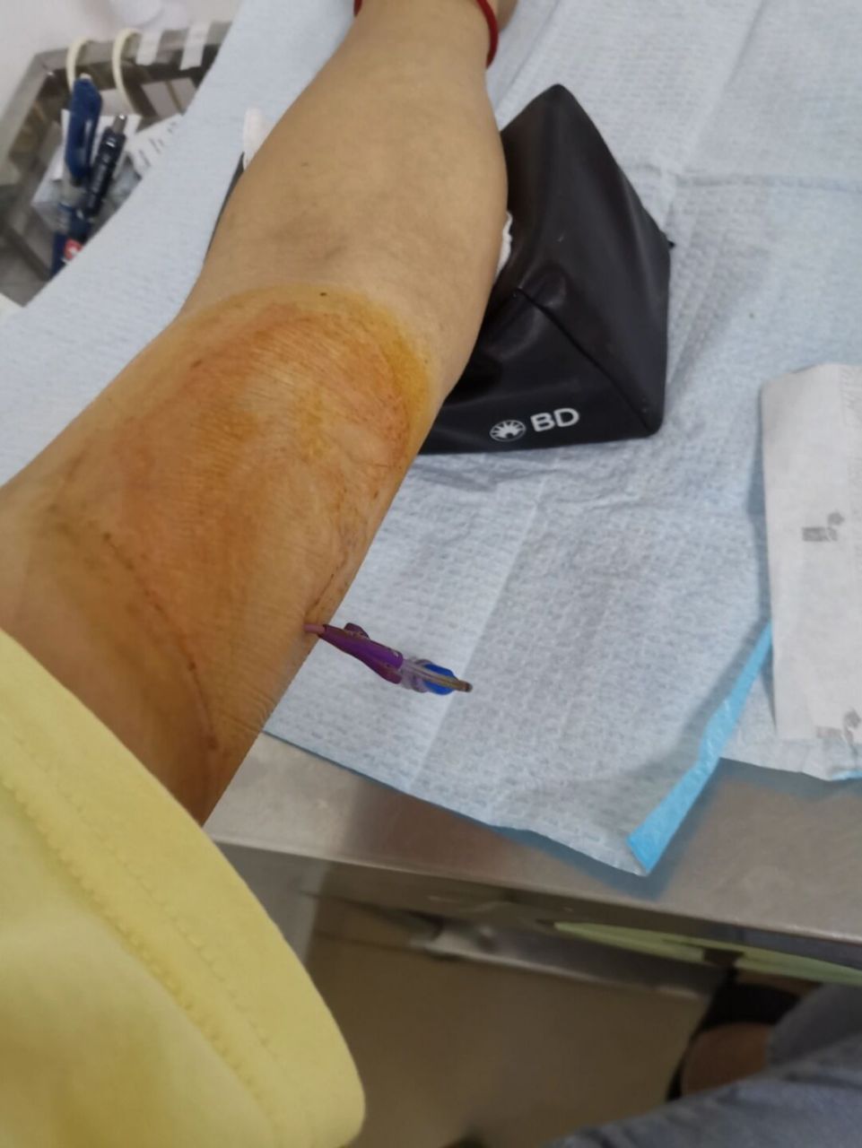 【化疗结束】picc拔管 [庆祝][庆祝]9/30进行了最后一次化疗,那天人