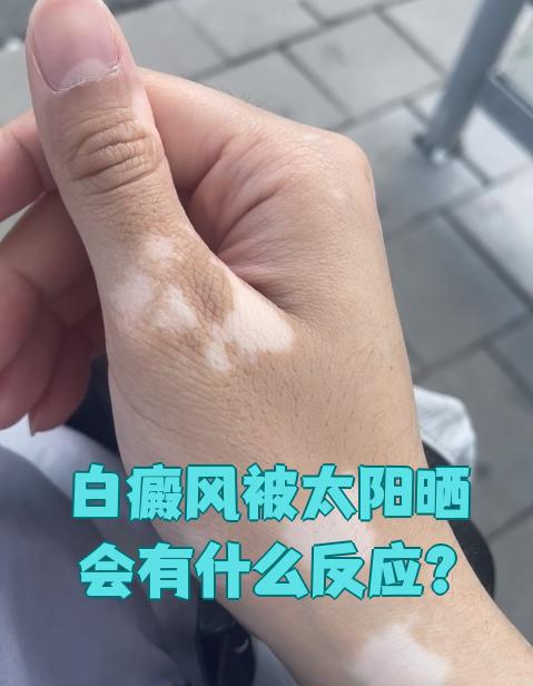 这是因为紫外线直接刺激了白斑部位的脆弱皮肤