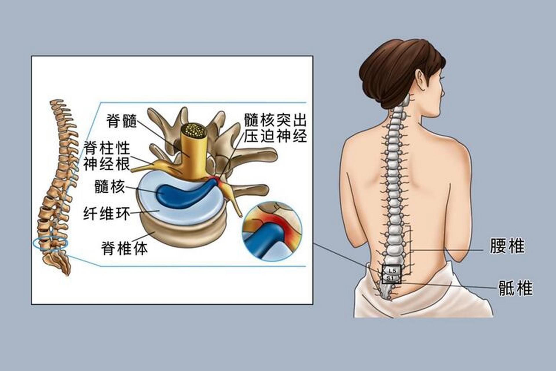 负荷和活动的主要承担部位,易出现退变和损伤,故腰椎间盘突出多发于此