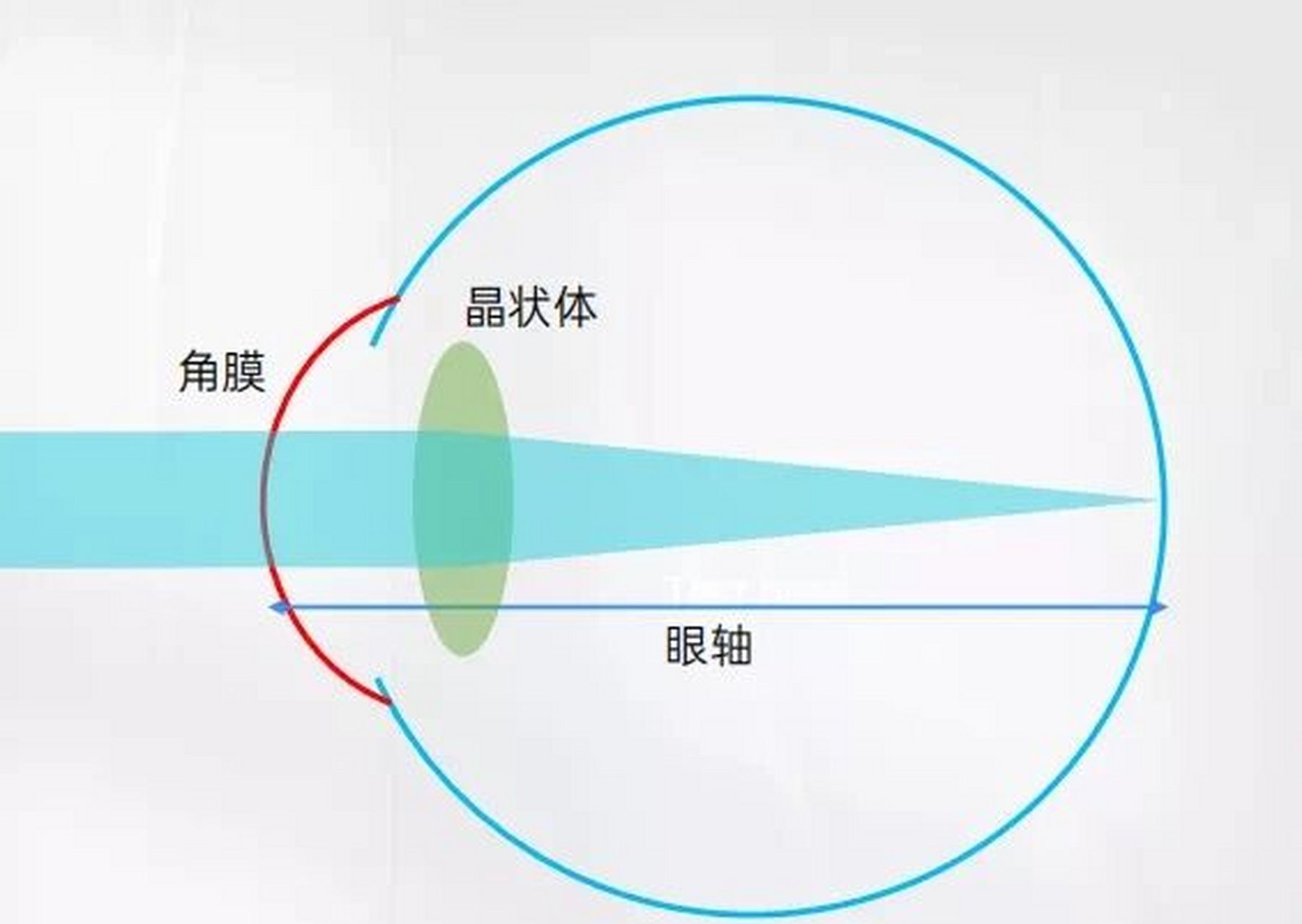 近视的视光学知识 近视的本质是成像点在视网膜前,看远处不清晰,但看
