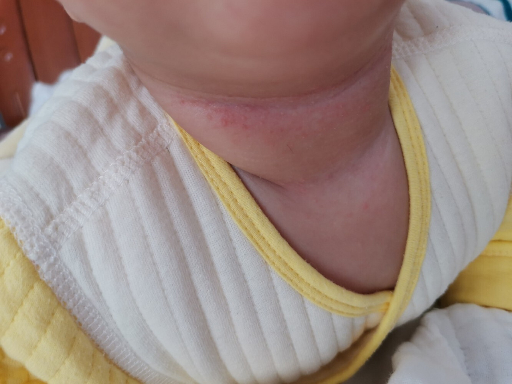 宝宝脖子起小痘痘 五个月的宝宝,脖子上起了红色的小痘痘,很是担心
