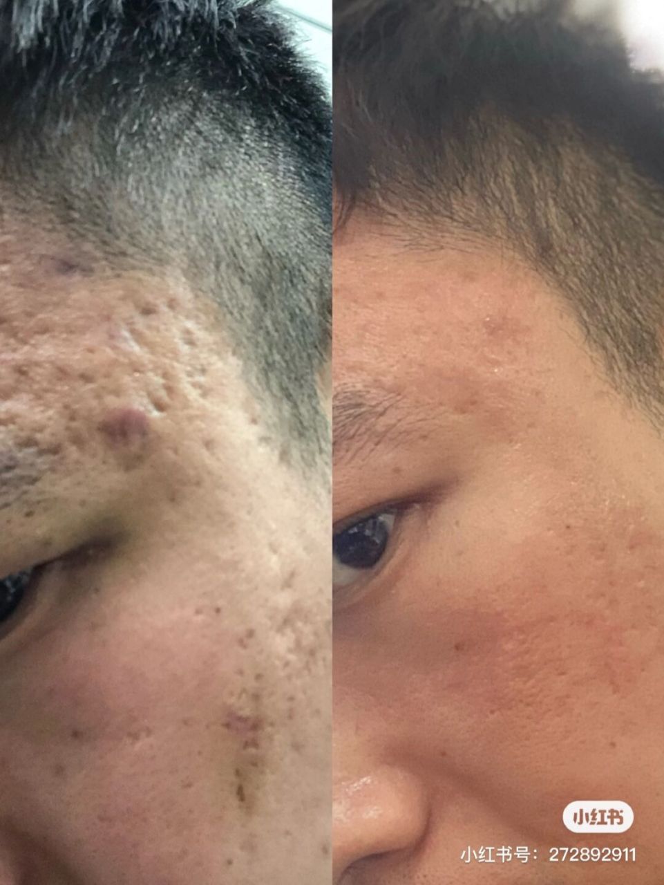 痘坑治疗对比 他做了两次点阵治疗和2次prp治疗的效果.