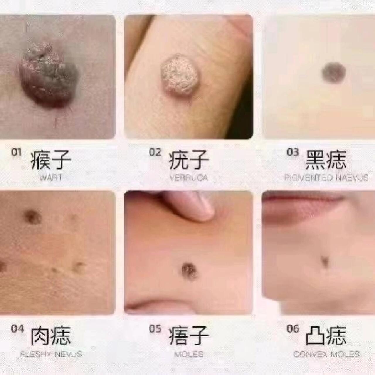 袪疣袪痣,让你变得更漂亮