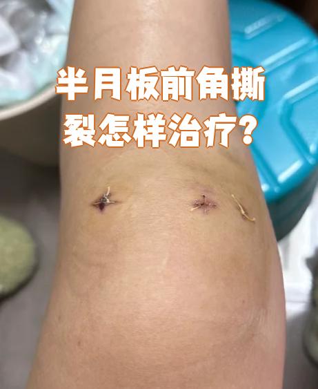 半月板前角撕裂的治疗方法主要分保守治疗和手术治疗两种