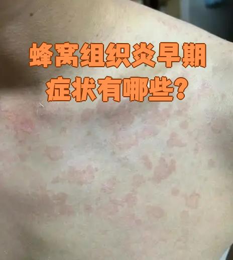 蜂窝组织炎早期症状有哪些?