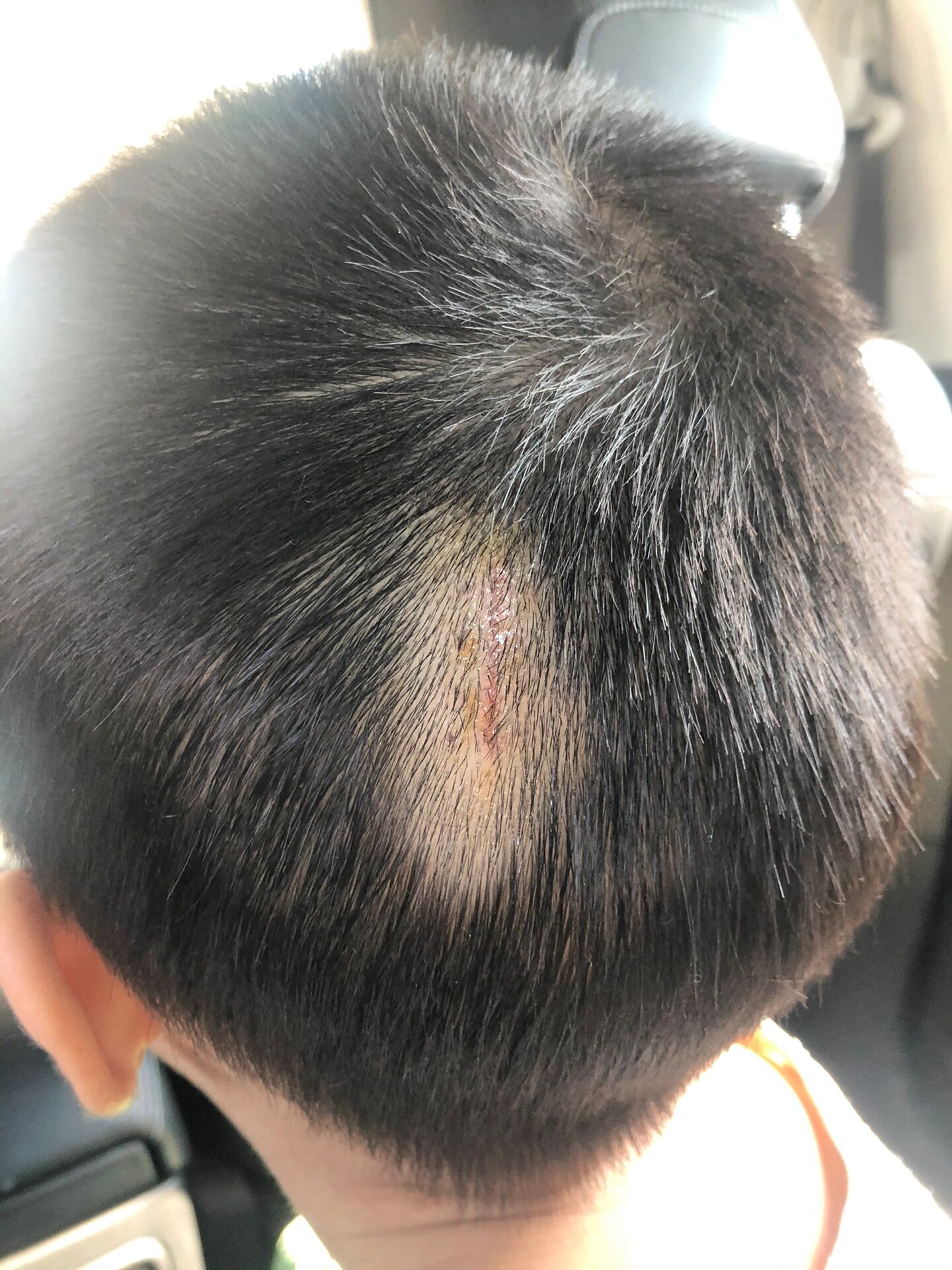 头部缝针,怎么护理