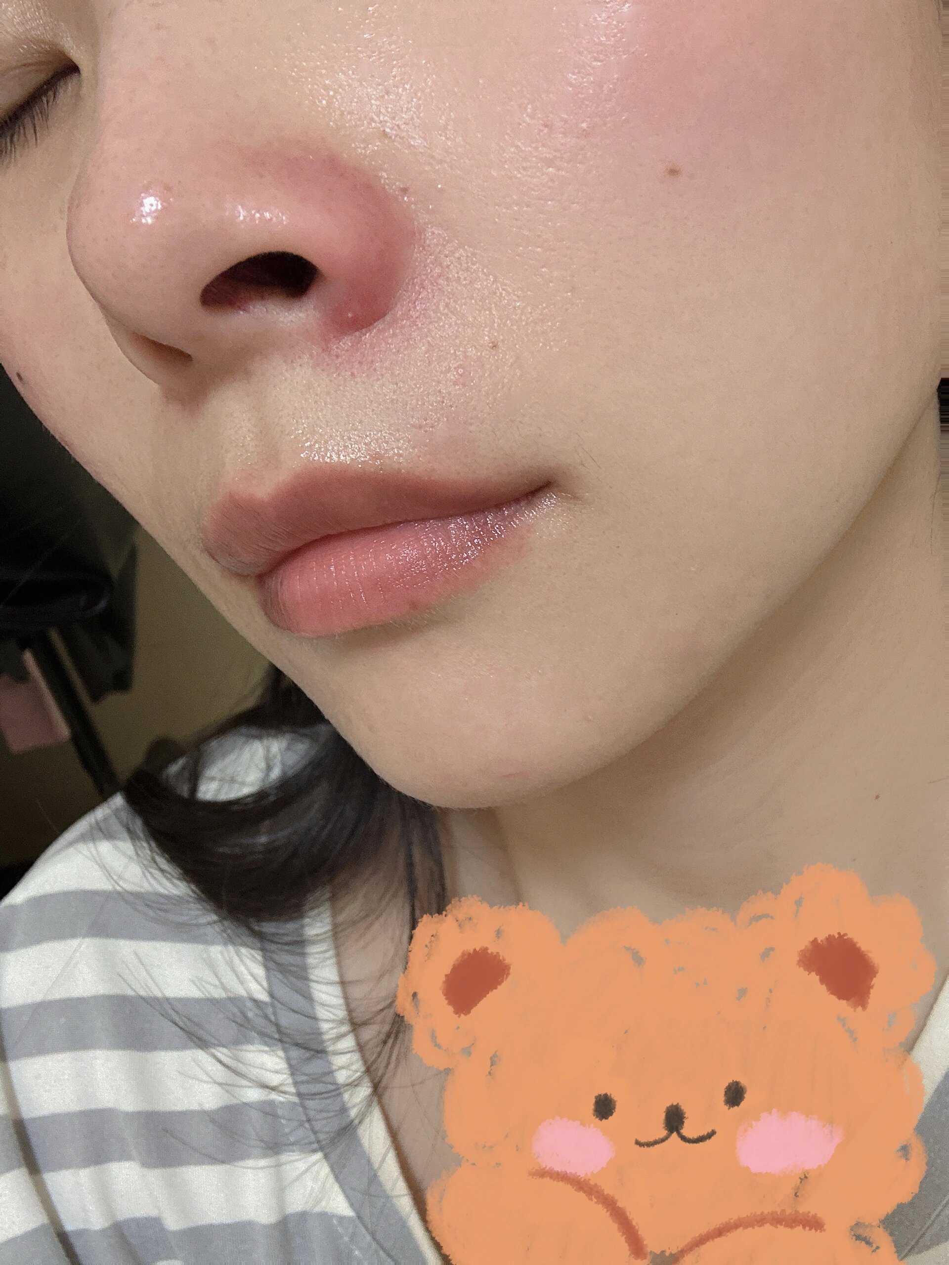 鼻翼一侧红肿且痛这是咋回事?