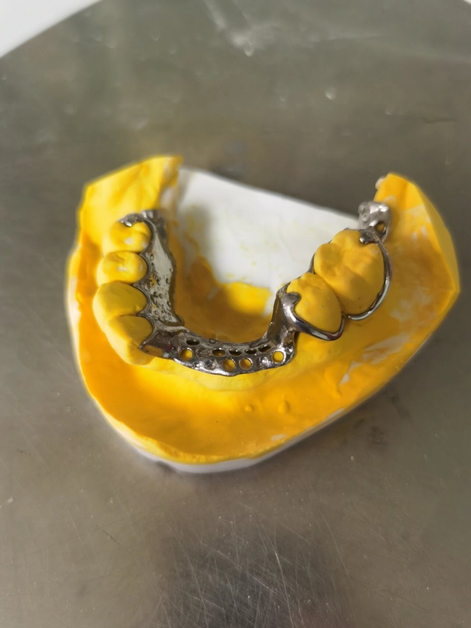 日常plog# #种植牙# #活动假牙# #牙匠之家# #我的日常# #支架##撼栽