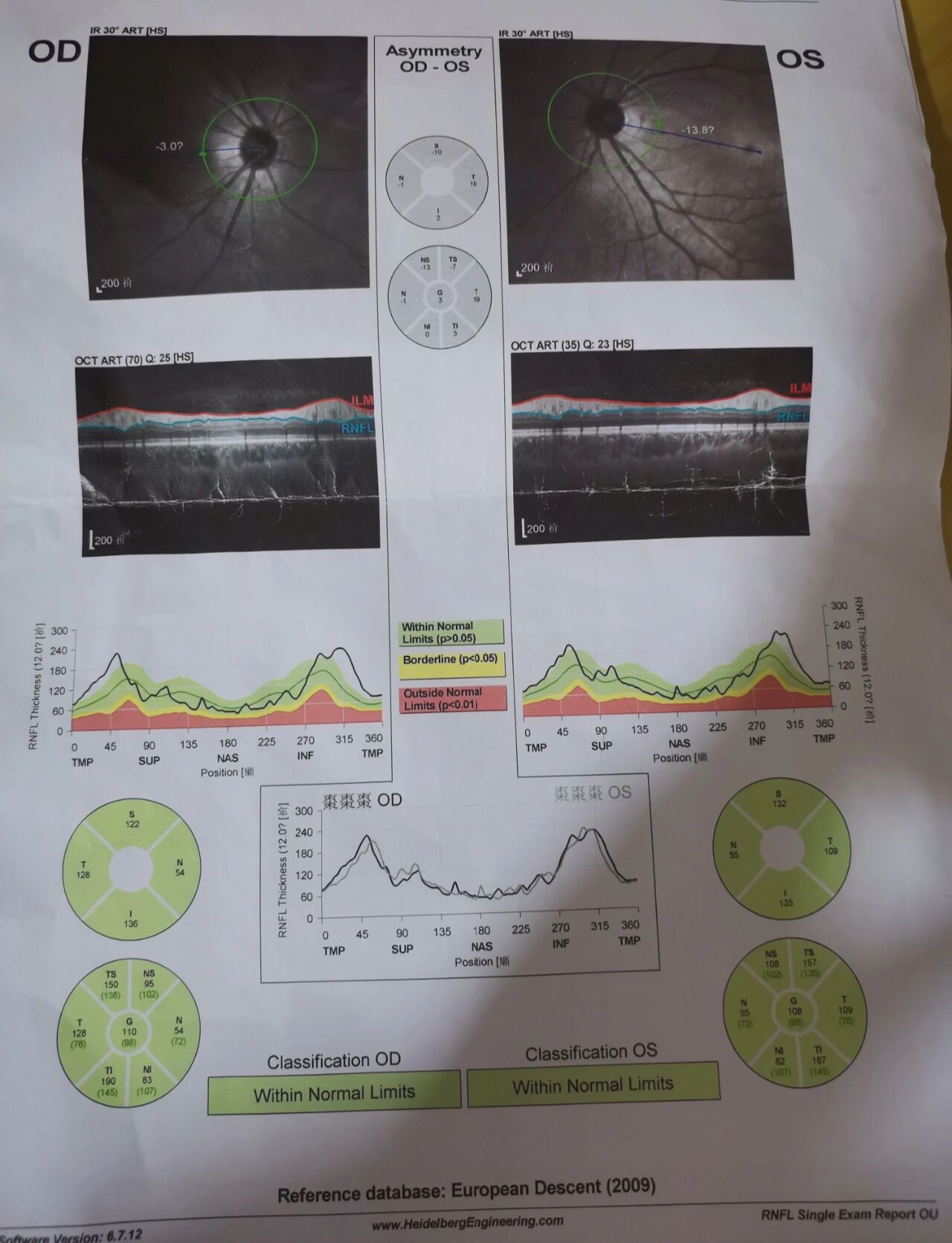 oct眼底视神经检查 高度近视,做了oct视神经检查,有人知道灰色圆盘