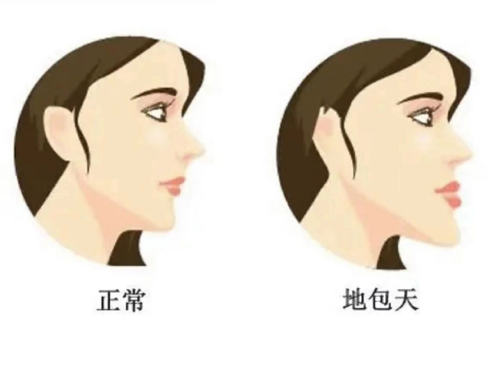 地包天的危害 地包天的危害主要有四个方面: 第一个,容貌,下颌前突会