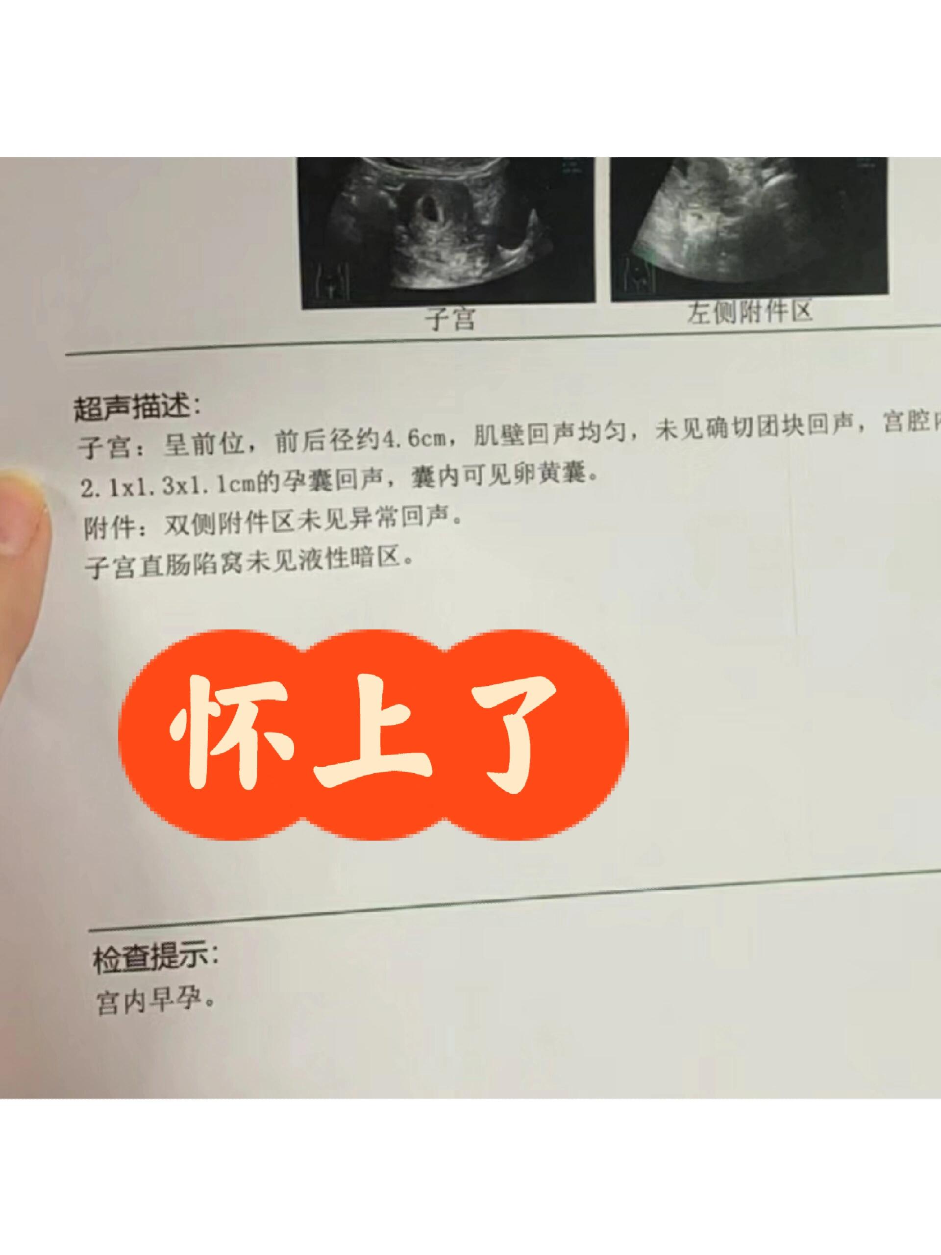 第35天的时候,阴超就能看见附件区的包块了,最