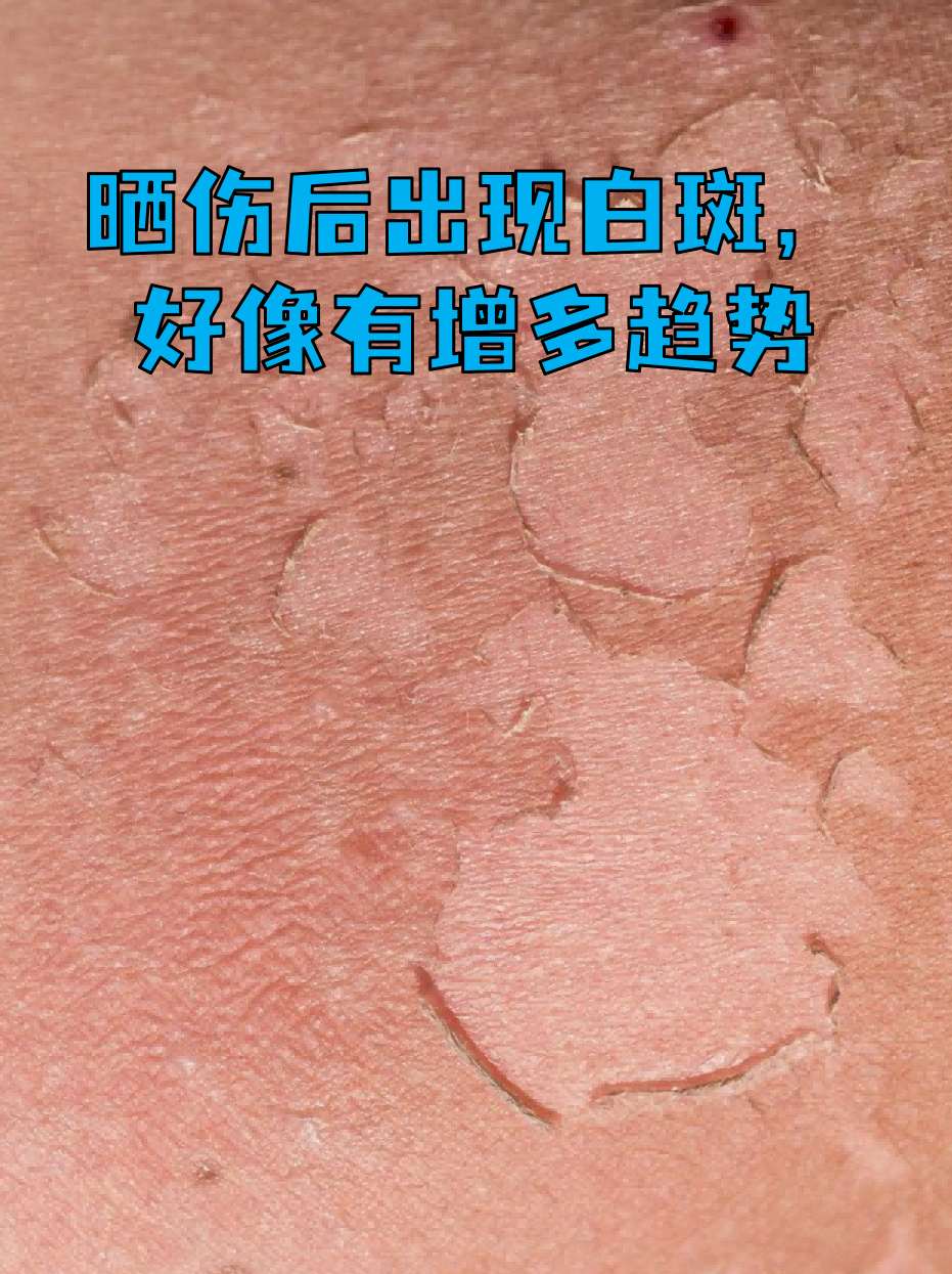 晒伤后出现白斑,好像有增多趋势