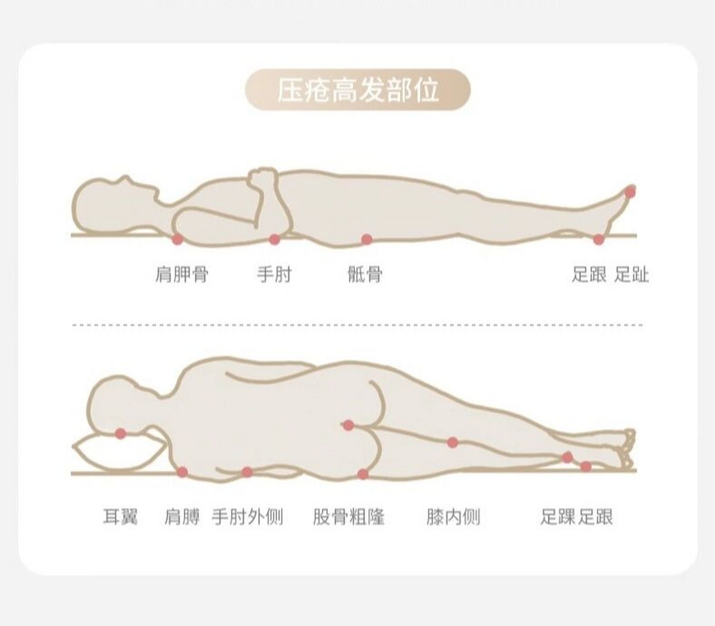 压力:垂直压力是造成压疮的最主要因素