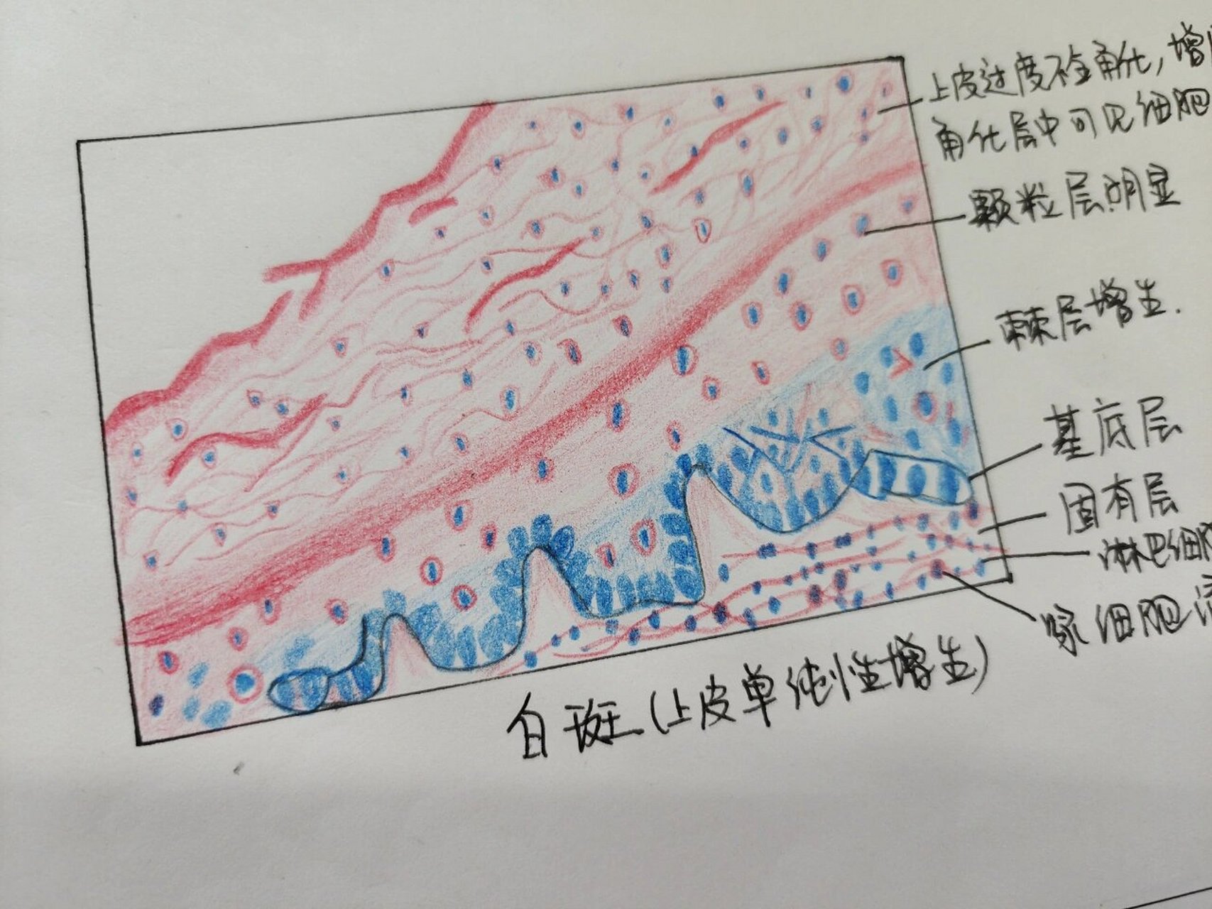 口腔组织病理学绘图 根尖肉芽肿 白斑
