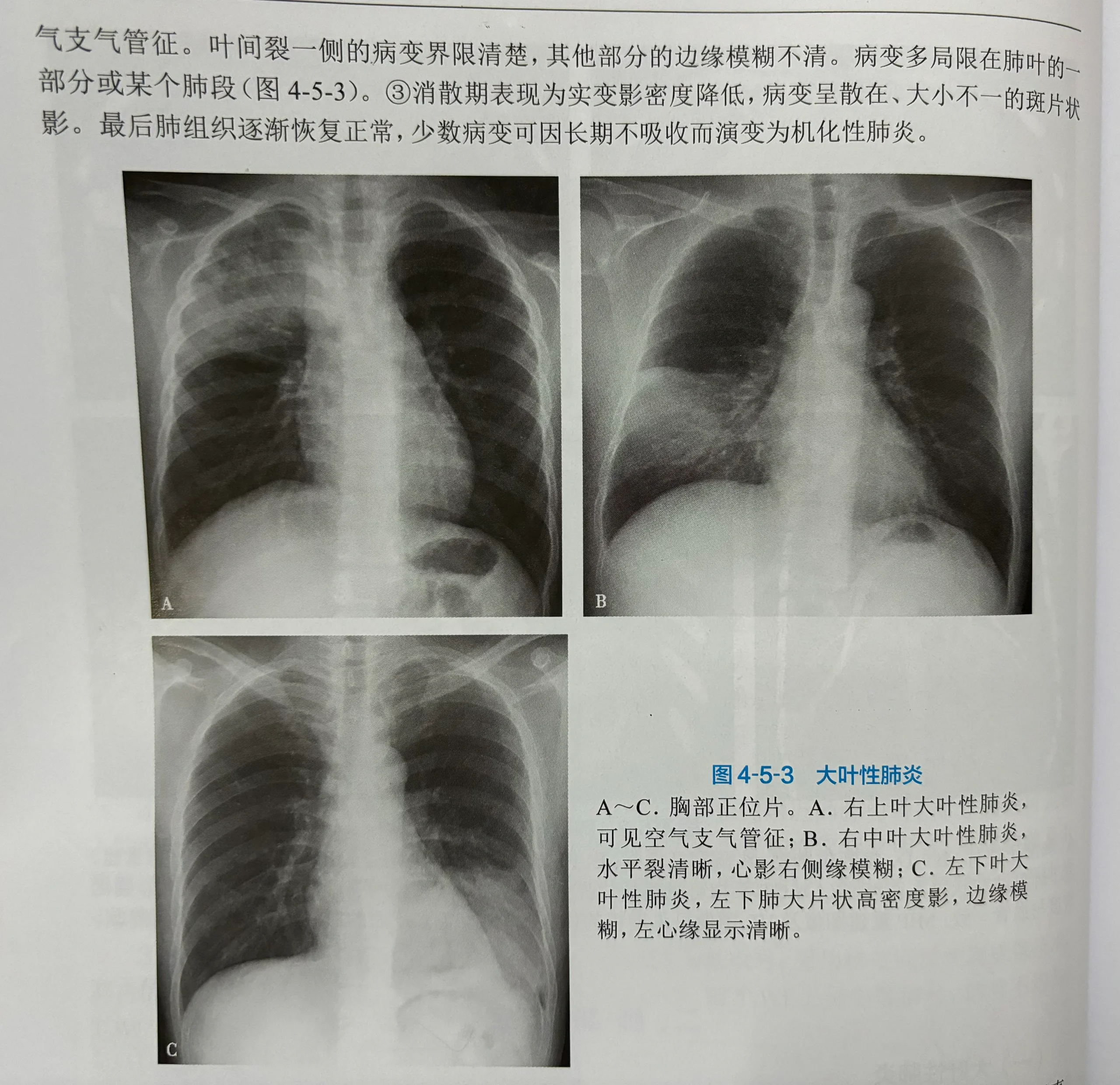 支气管肺炎ct图片图片