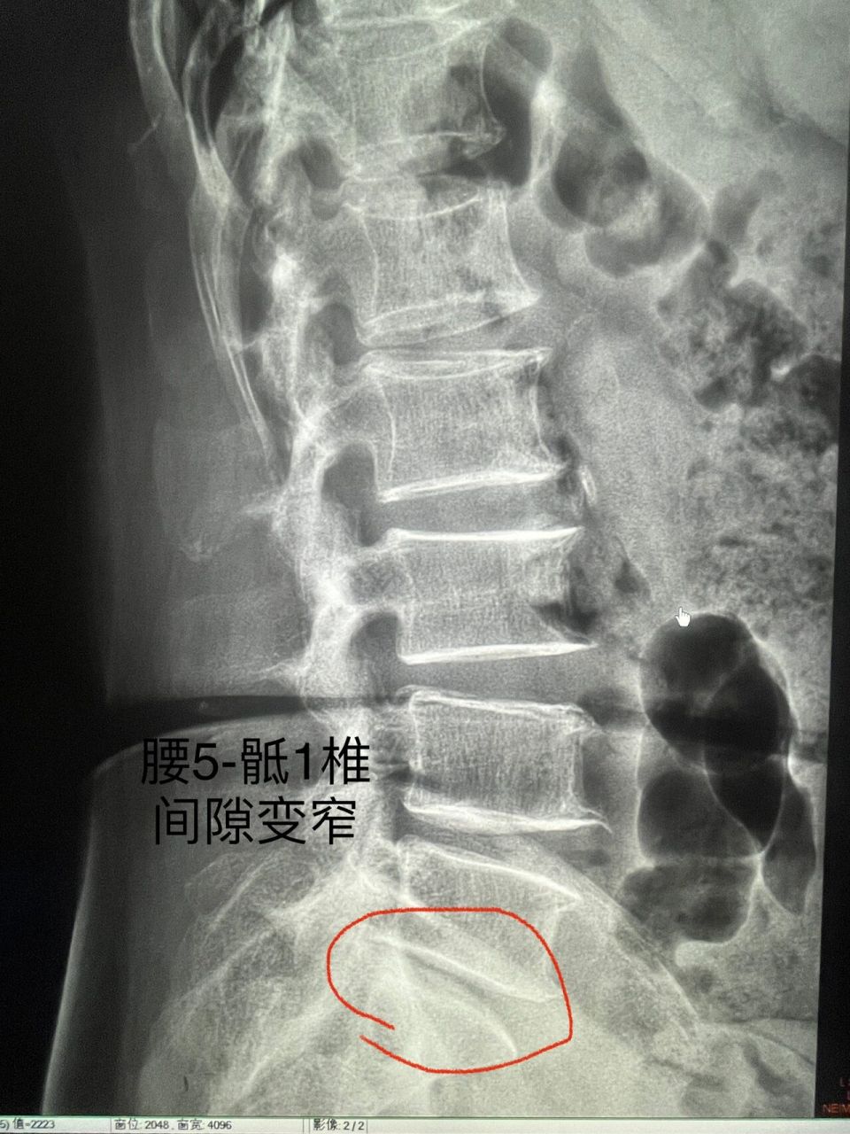 影像读片|第21566天|腰椎退行性改变 今天给大家带来腰椎相关病变