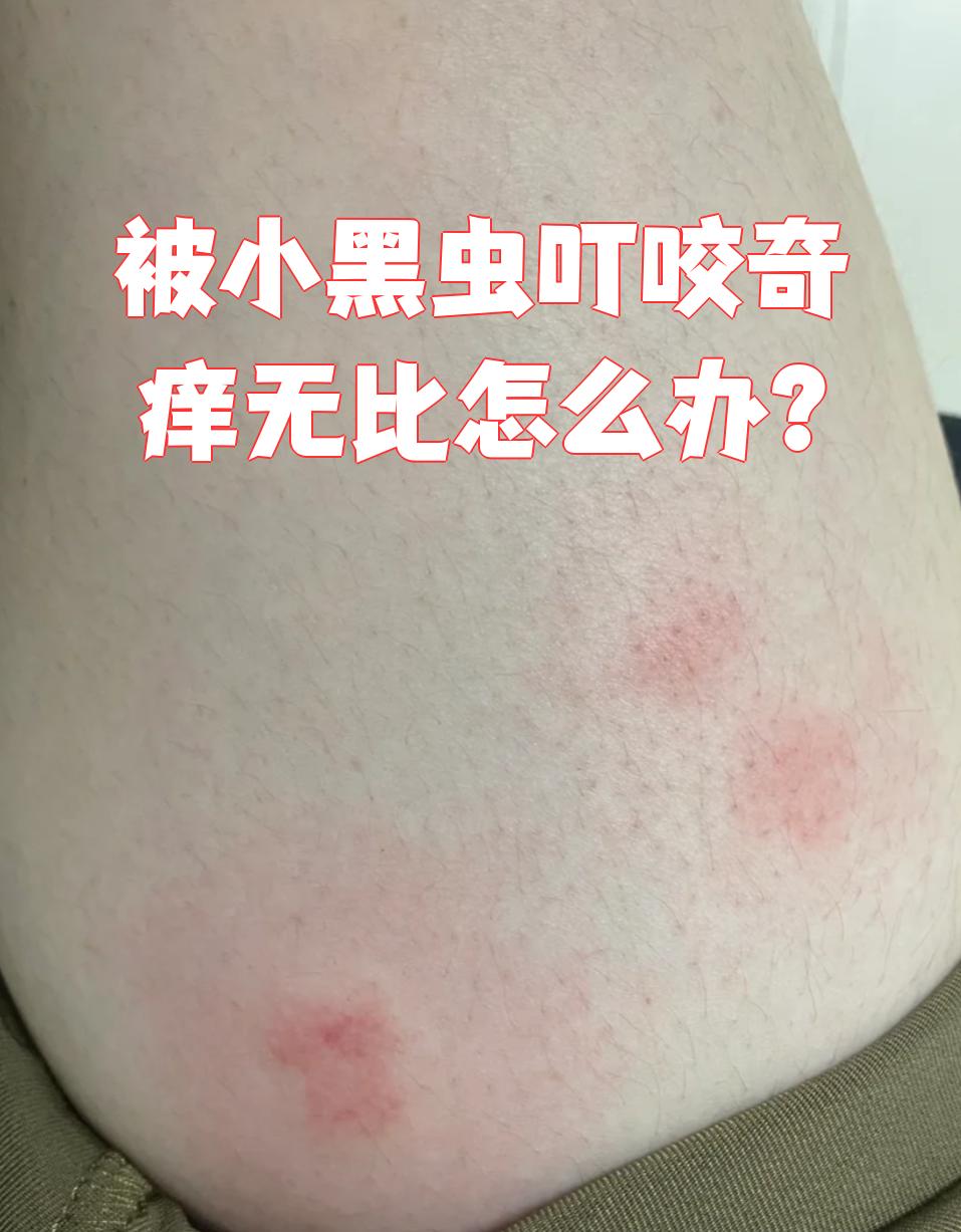 被小黑虫叮咬后特别痒,处理办法要看具体症状