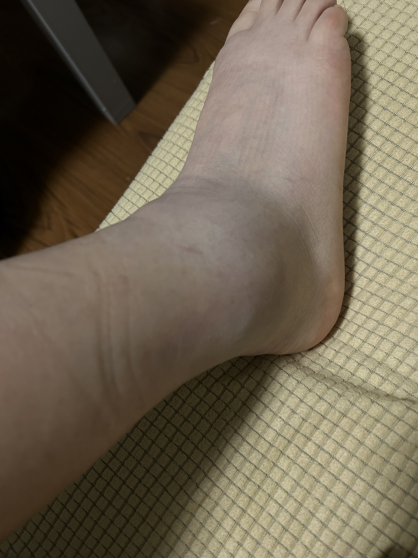 扭脚一个月 终于正常走路了 还是有一点点痛