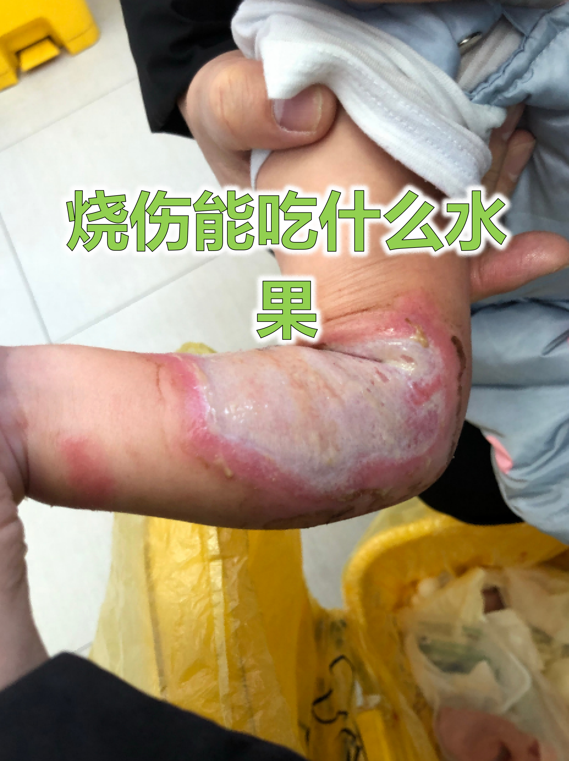 烧伤能吃什么水果