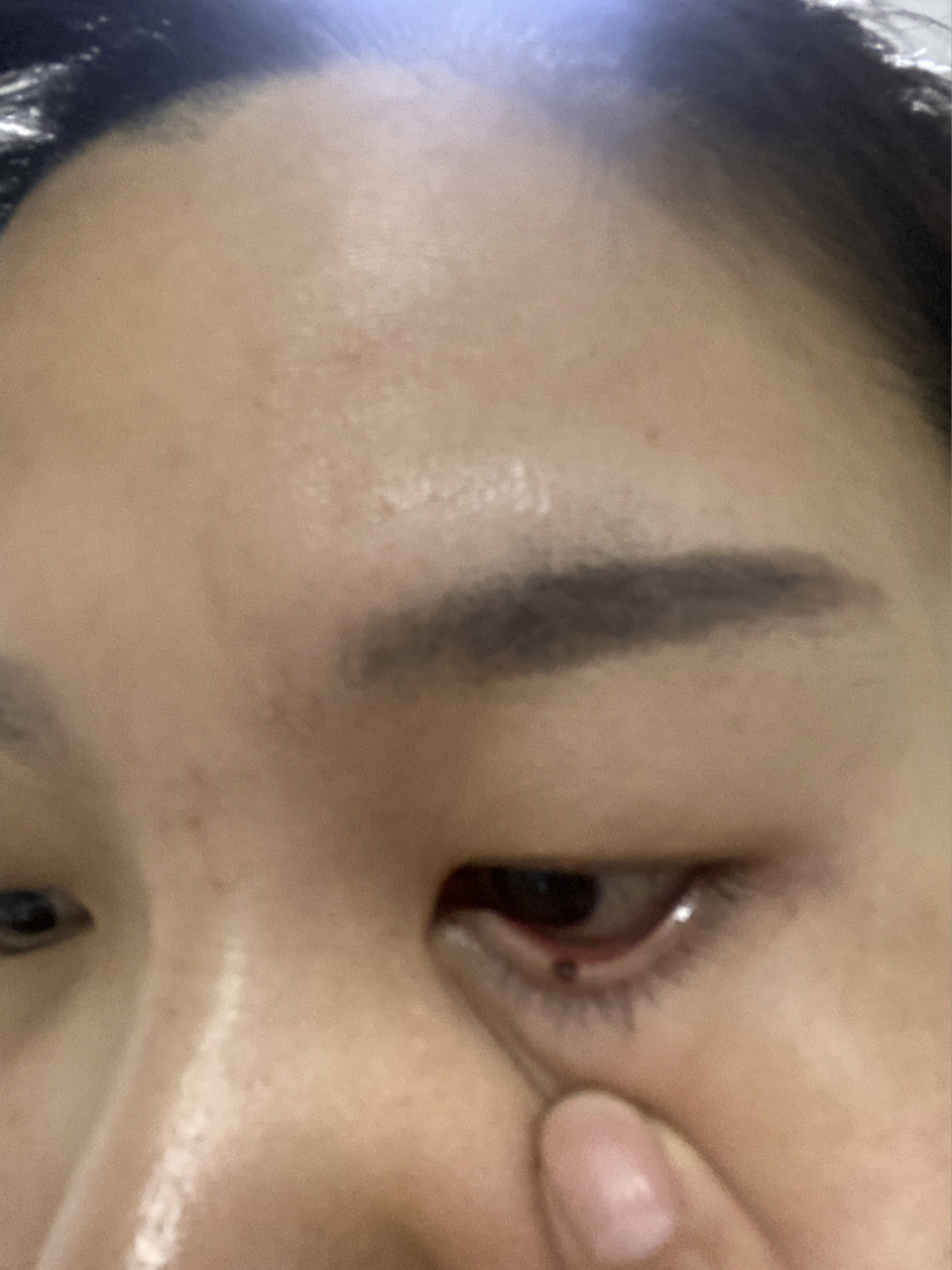 眼睑上长了一颗凸出的红痣,会不会有危险