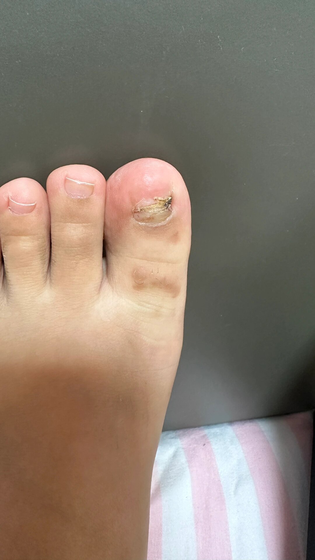 当时已经没有痛感,赶紧打电话找家人去了急诊,当