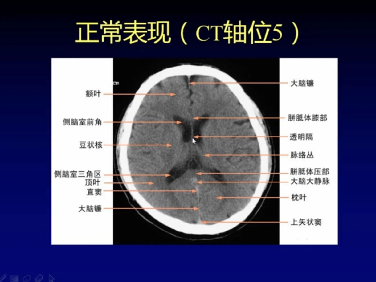 正常脑部ct影像图