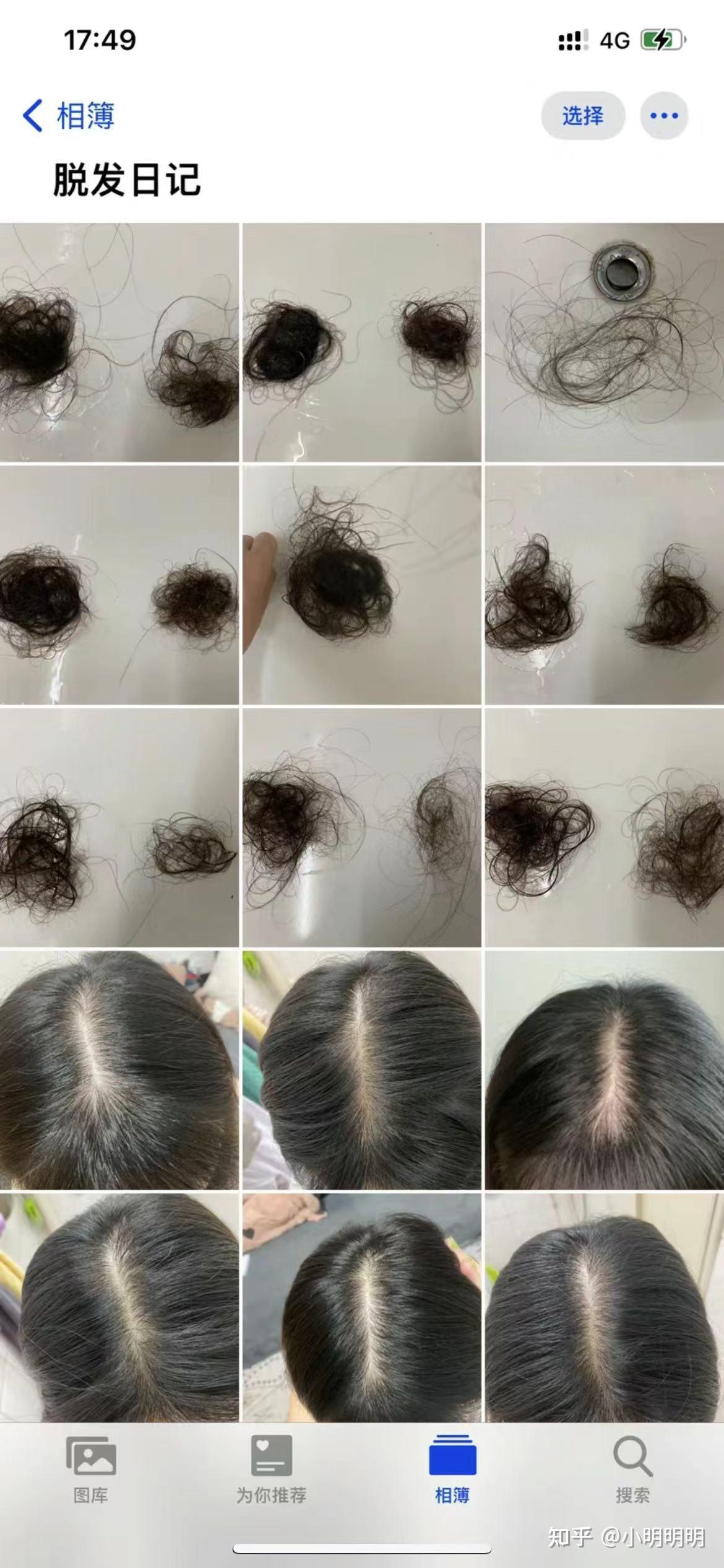 发缝越来越宽头发越掉越多真的害怕秃顶求真实有效的防脱方法皮肤科
