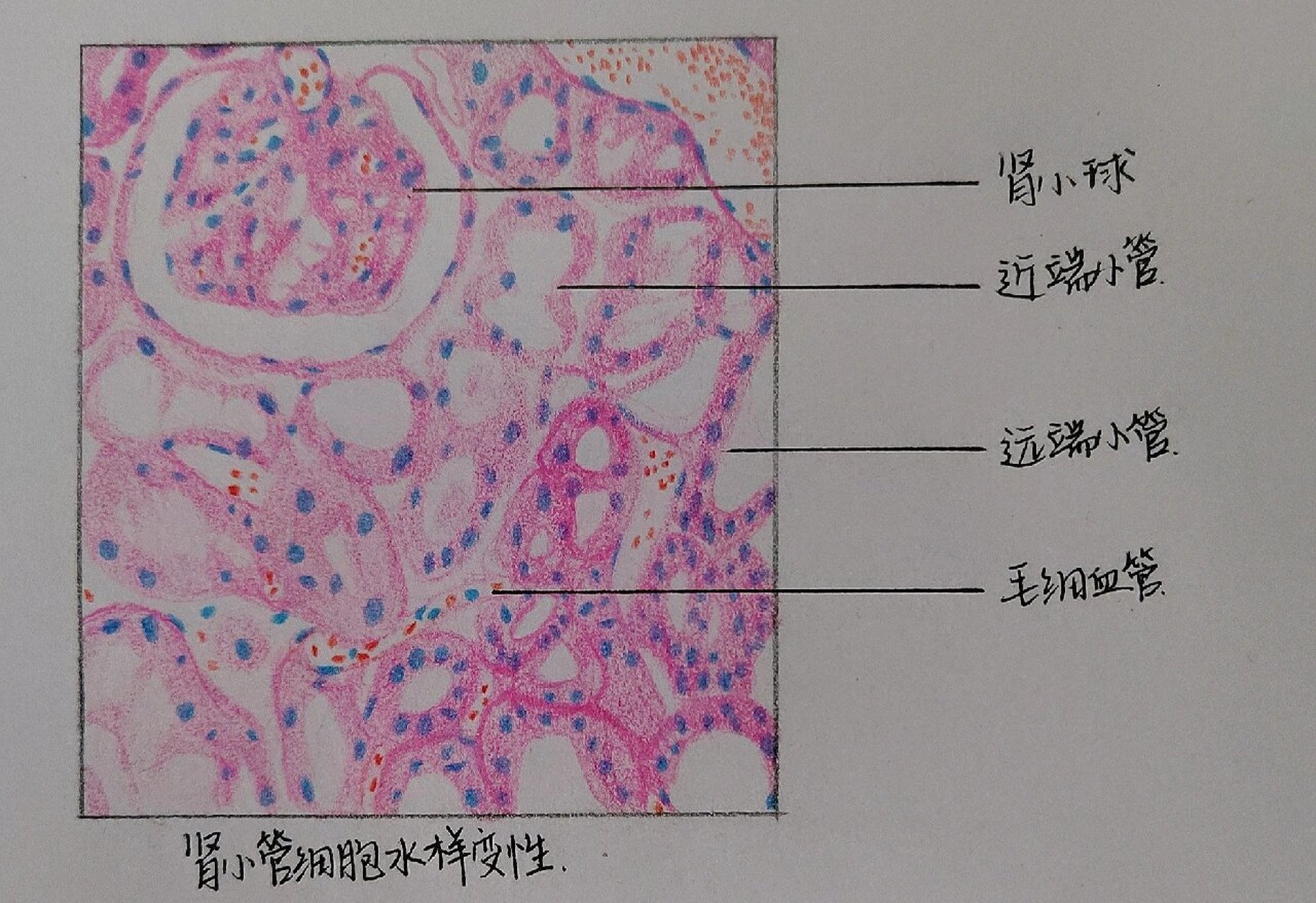 肾小管细胞水样变性 病理切片手绘图