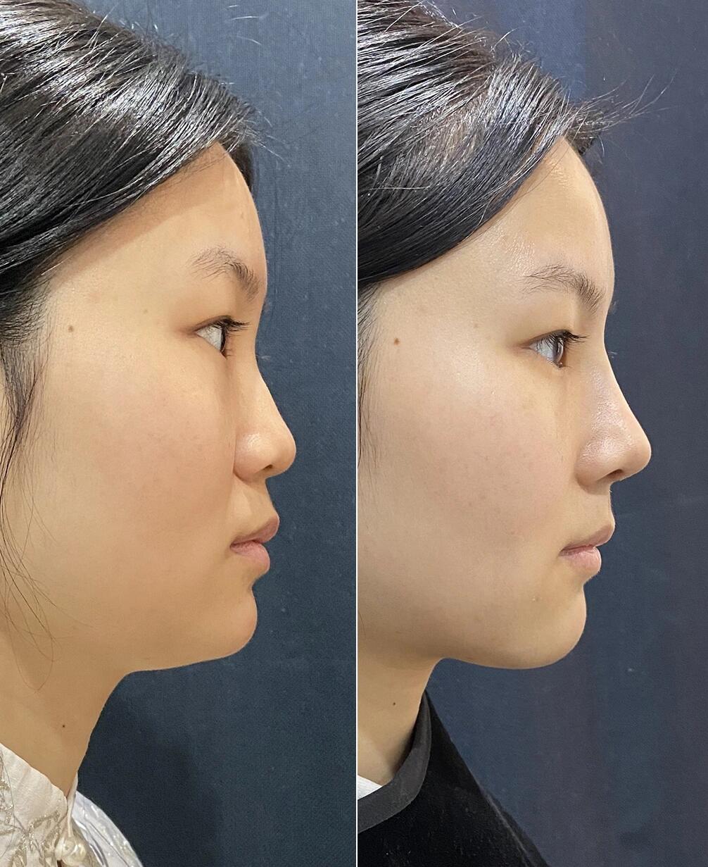 做鼻子怎么选?20天后的高清案例对比