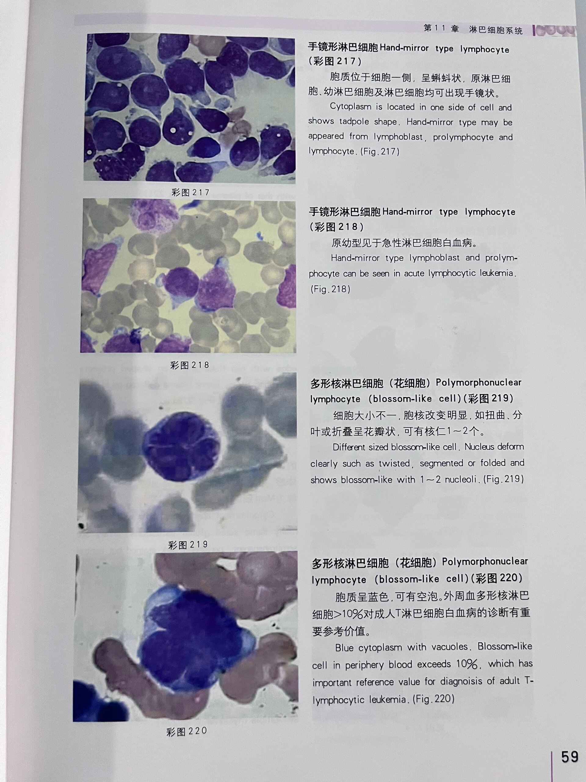 正常淋巴细胞图片