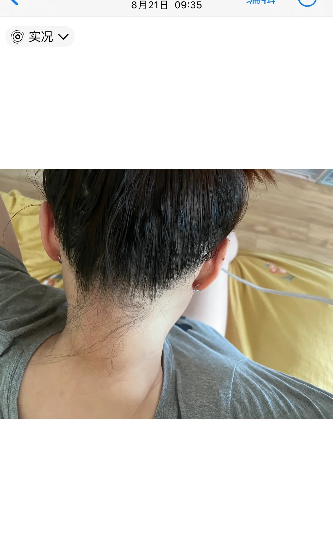 确诊二型糖尿病后4个月的黑棘皮变化情况 2020年就有黑棘皮,但医生说