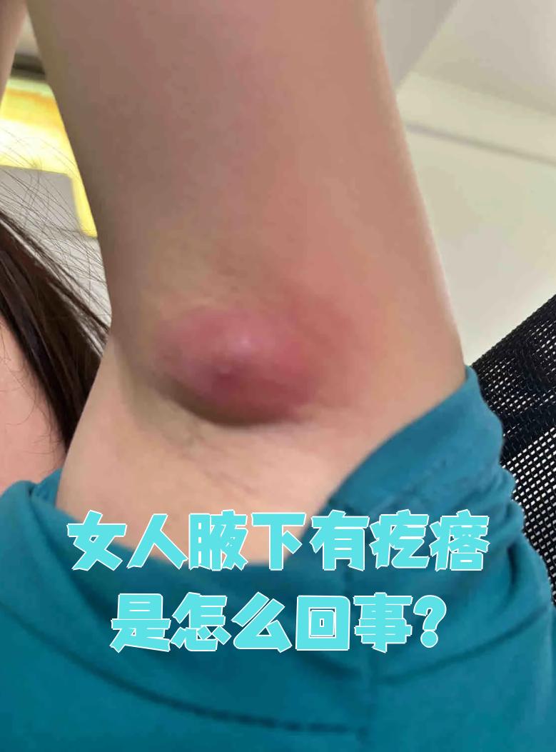 女性腋下出现疙瘩,最常见的原因是皮脂腺囊肿或淋巴结炎症