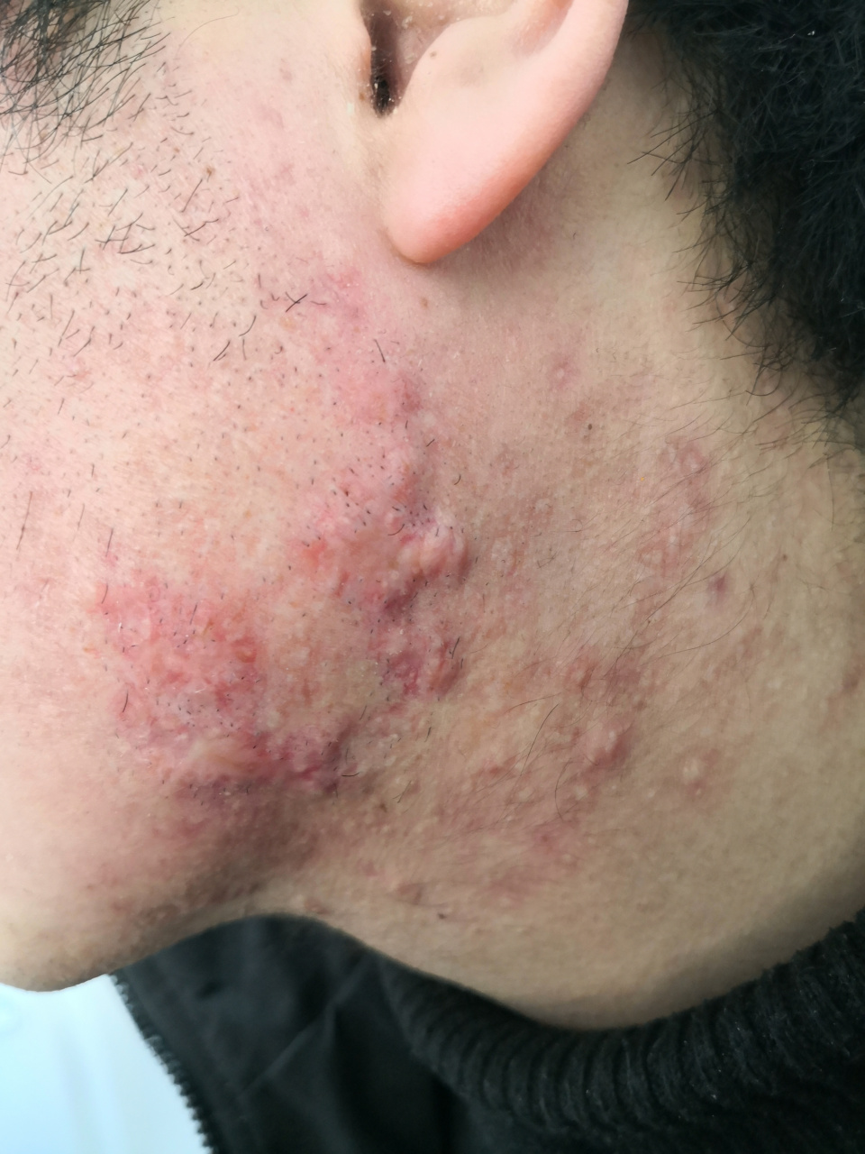 治疗一段时间后出现明显减轻#痤疮##疤痕# 继续治疗可以更好一些