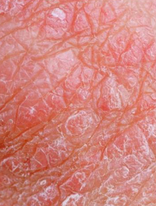 龟头痒红是常见症状,主要表现为龟头皮肤发痒,发红