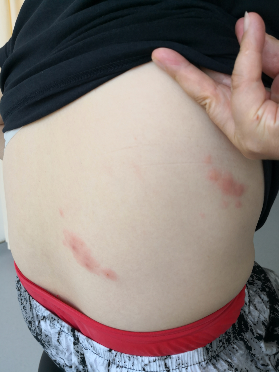 右侧肋下散发片状鲜红色斑点水疱症状.刺痛感.第二次发病.带状疱疹.