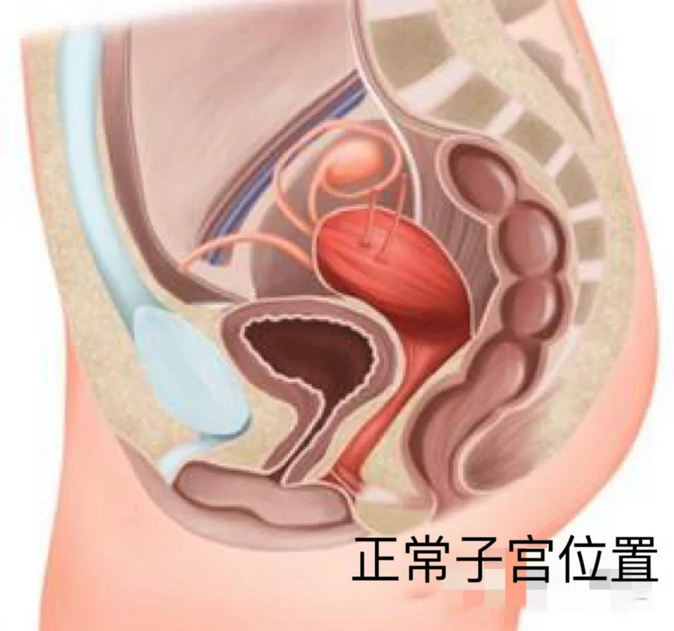 重度子宫脱垂患者 60岁的阿姨,顺产过两个孩子,因有肿物从yd口脱出来