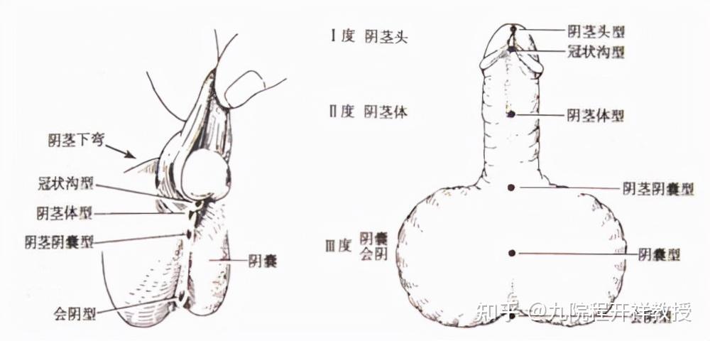 尿道下裂的病因分类以及治疗方法有哪些