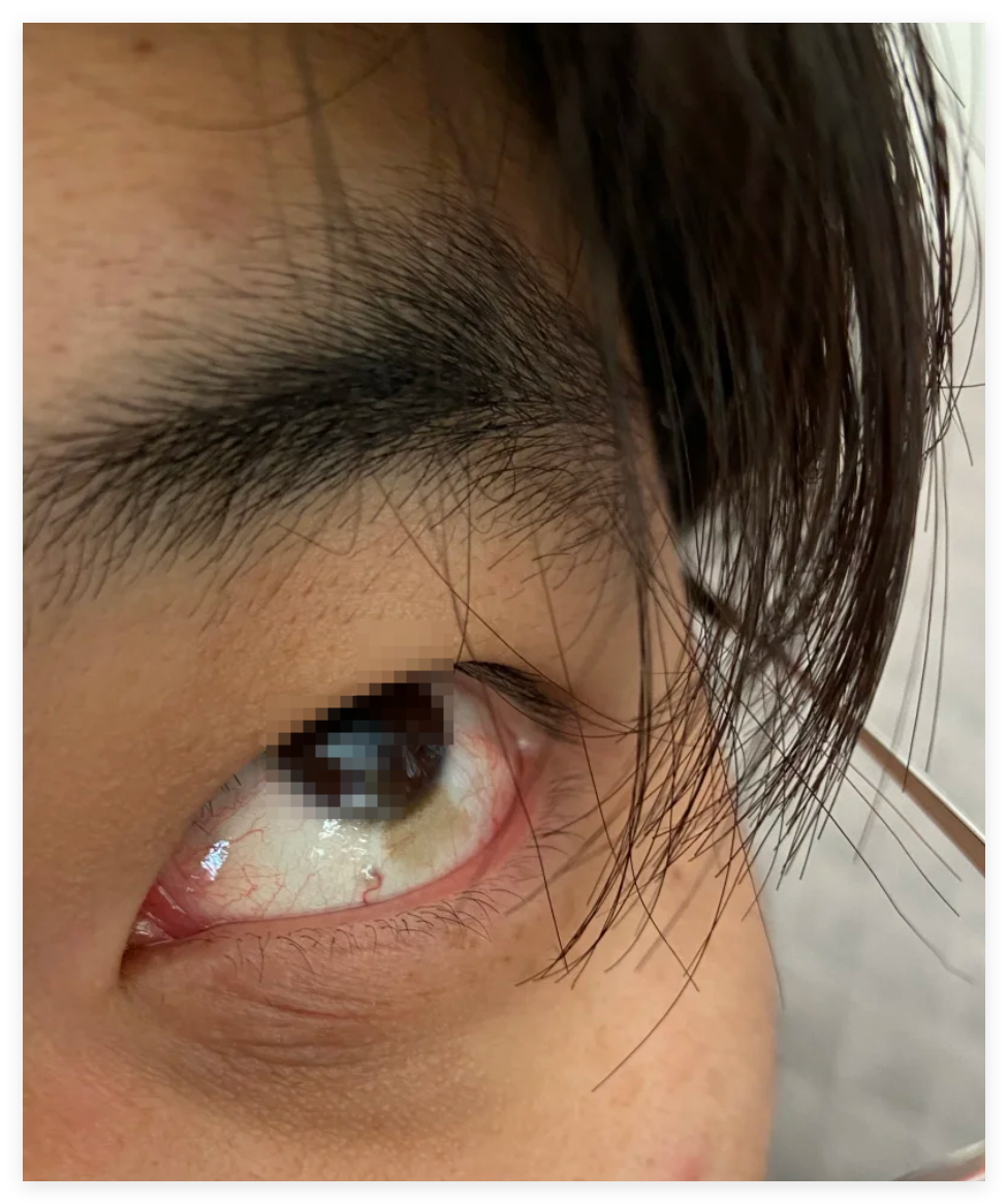 眼睛下半部分发黄可能和日常习惯有关,也可能是某些疾病引起的