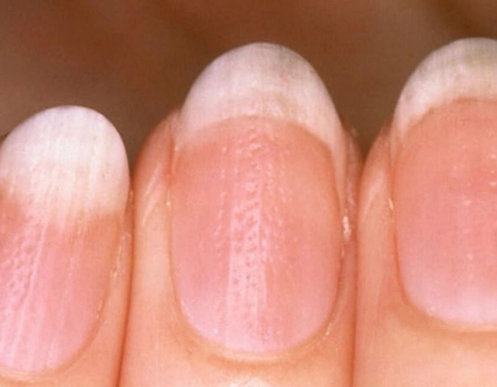 缺钙还是缺微量元素? 指甲可以反映人体的营养状况.